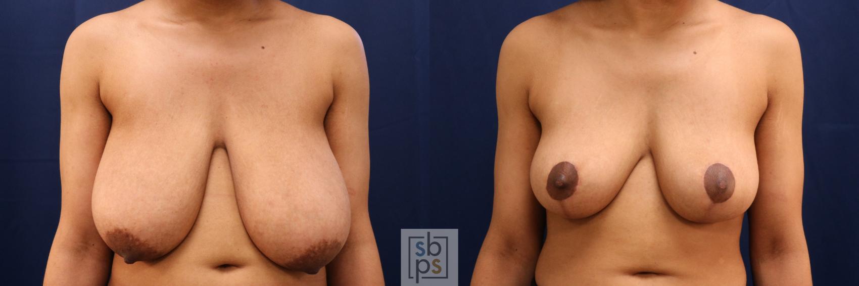 Before & After Breast Reduction Case 765 Front View in Los Angeles, Torrance & Long Beach, CA