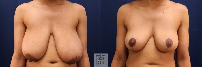 Before & After Breast Reduction Case 765 Front View in Los Angeles, Torrance & Long Beach, CA