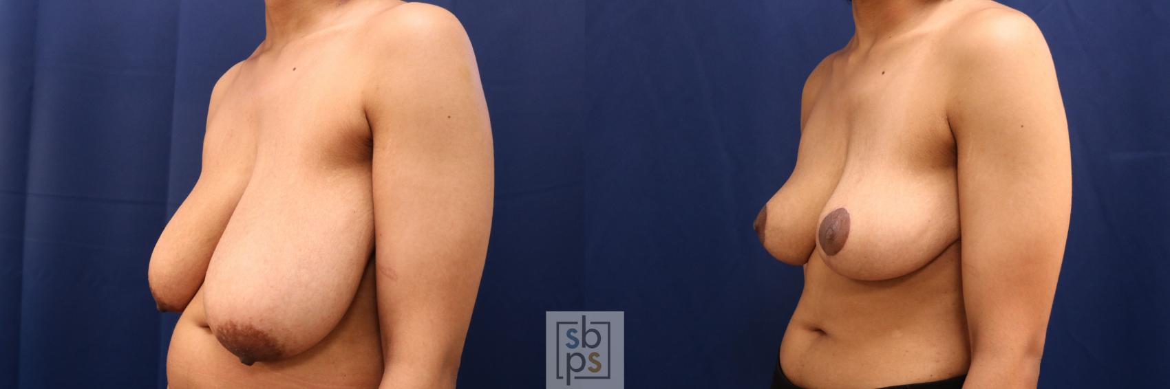 Before & After Breast Reduction Case 765 Left Oblique View in Los Angeles, Torrance & Long Beach, CA
