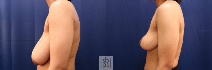 Before & After Breast Reduction Case 765 Left Side View in Los Angeles, Torrance & Long Beach, CA