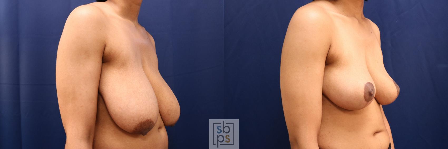 Before & After Breast Reduction Case 765 Right Oblique View in Los Angeles, Torrance & Long Beach, CA