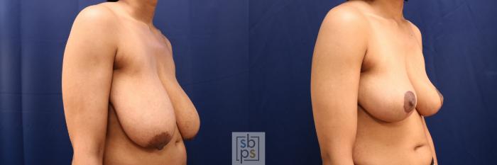 Before & After Breast Reduction Case 765 Right Oblique View in Los Angeles, Torrance & Long Beach, CA