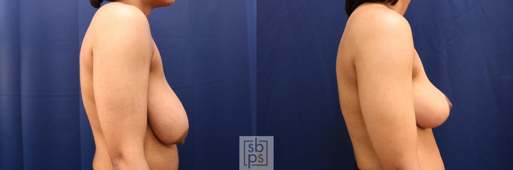 Before & After Breast Reduction Case 765 Right Side View in Los Angeles, Torrance & Long Beach, CA