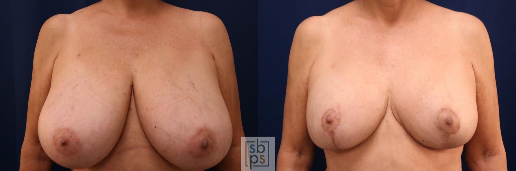 Before & After Breast Reduction Case 766 Front View in Los Angeles, Torrance & Long Beach, CA