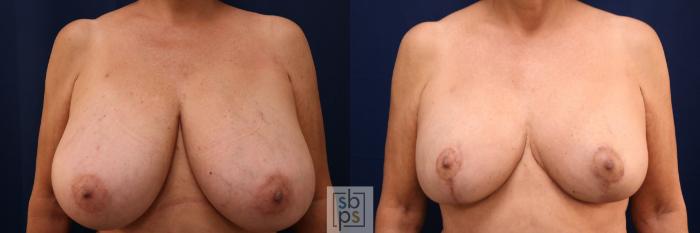 Before & After Breast Reduction Case 766 Front View in Los Angeles, Torrance & Long Beach, CA