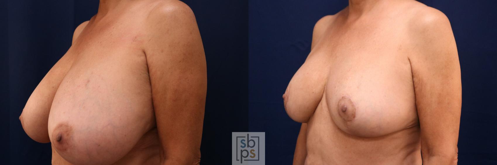 Before & After Breast Reduction Case 766 Left Oblique View in Los Angeles, Torrance & Long Beach, CA