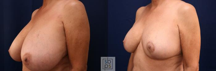 Before & After Breast Reduction Case 766 Left Oblique View in Los Angeles, Torrance & Long Beach, CA