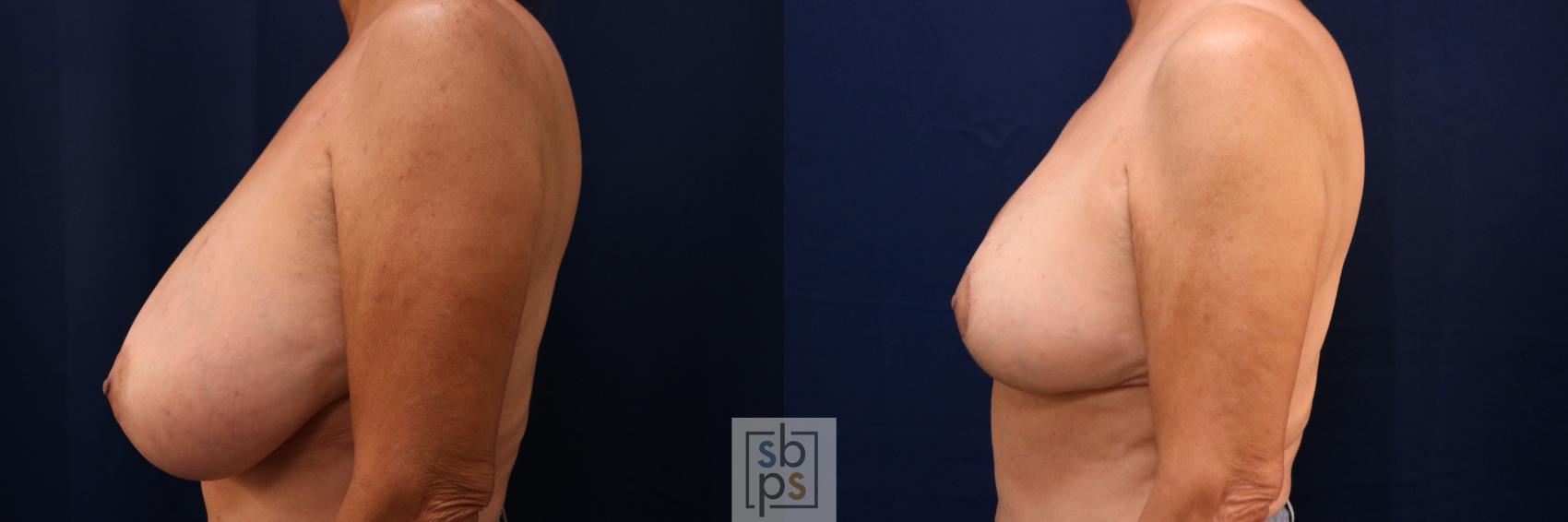 Before & After Breast Reduction Case 766 Left Side View in Los Angeles, Torrance & Long Beach, CA