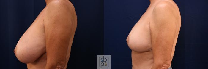 Before & After Breast Reduction Case 766 Left Side View in Los Angeles, Torrance & Long Beach, CA