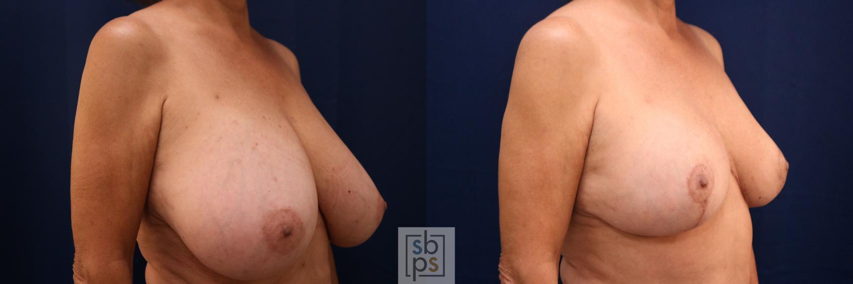 Before & After Breast Reduction Case 766 Right Oblique View in Los Angeles, Torrance & Long Beach, CA