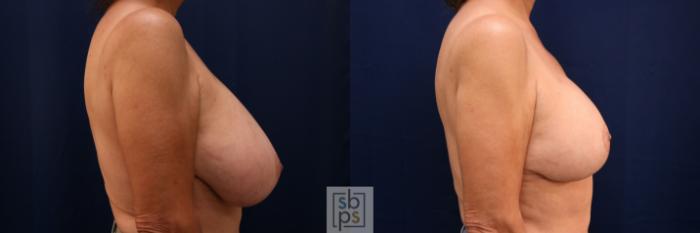 Before & After Breast Reduction Case 766 Right Side View in Los Angeles, Torrance & Long Beach, CA