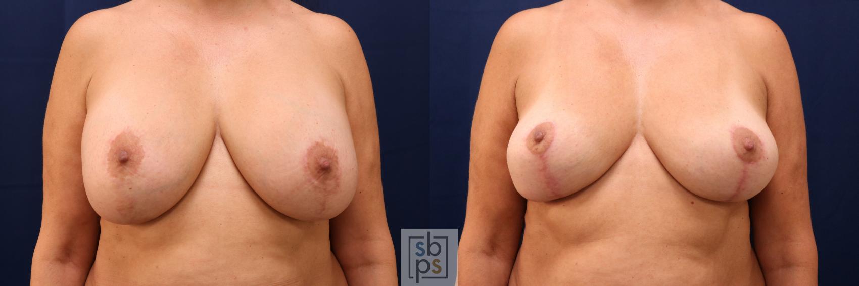 Before & After Breast Reduction Case 767 Front View in Los Angeles, Torrance & Long Beach, CA