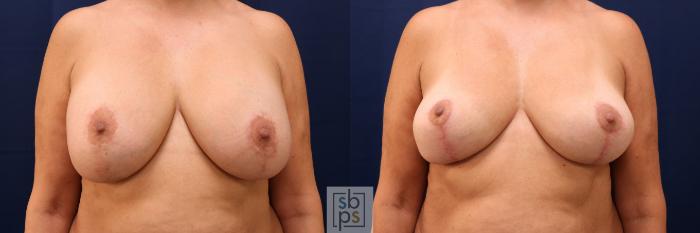 Before & After Breast Reduction Case 767 Front View in Los Angeles, Torrance & Long Beach, CA
