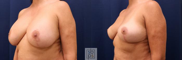 Before & After Breast Reduction Case 767 Left Oblique View in Los Angeles, Torrance & Long Beach, CA