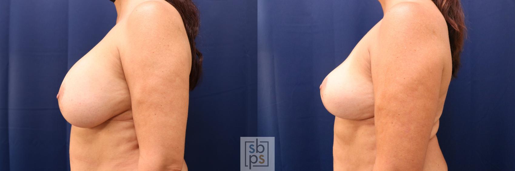 Before & After Breast Reduction Case 767 Left Side View in Los Angeles, Torrance & Long Beach, CA