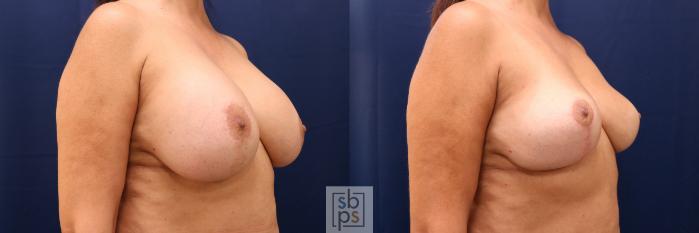 Before & After Breast Reduction Case 767 Right Oblique View in Los Angeles, Torrance & Long Beach, CA