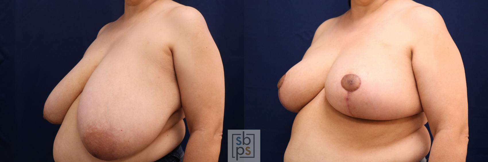 Before & After Breast Reduction Case 768 Left Oblique View in Los Angeles, Torrance & Long Beach, CA