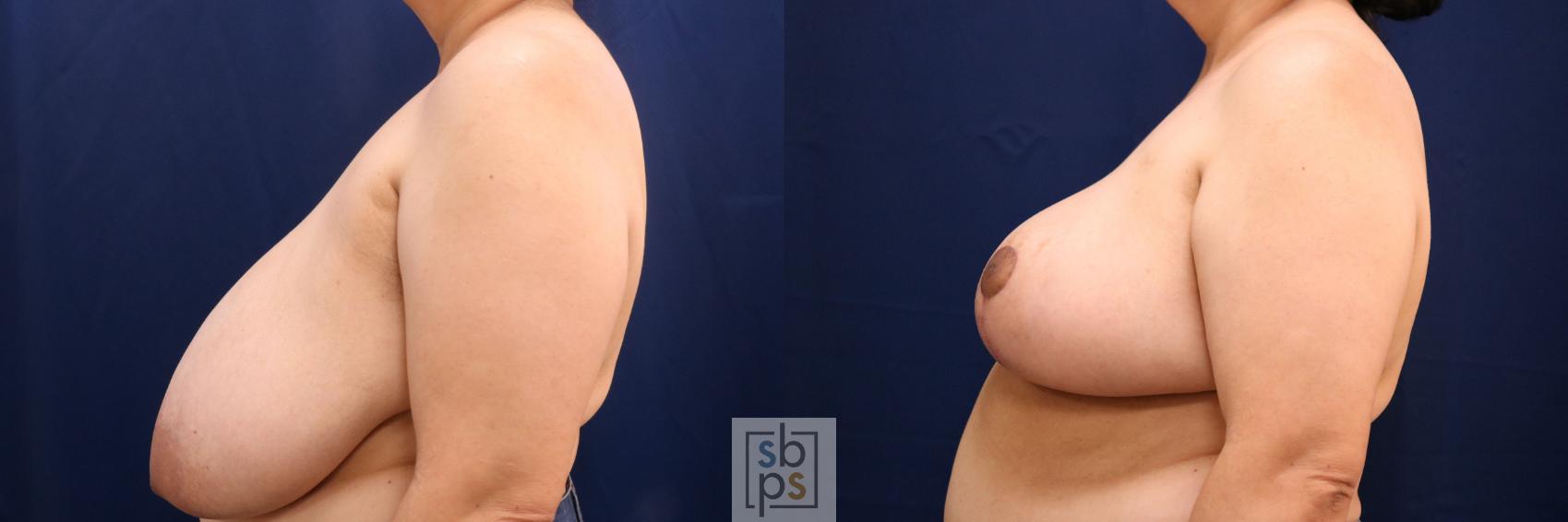 Before & After Breast Reduction Case 768 Left Side View in Los Angeles, Torrance & Long Beach, CA