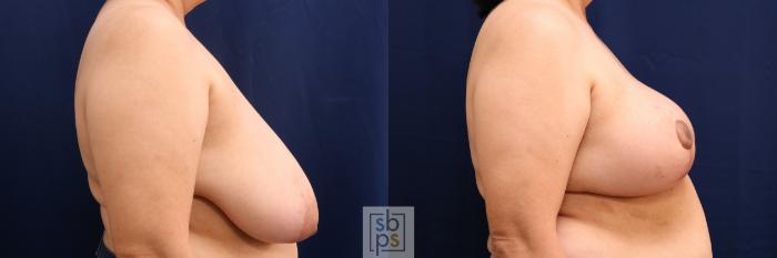 Before & After Breast Reduction Case 768 Right Side View in Los Angeles, Torrance & Long Beach, CA