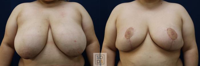 Before & After Breast Reduction Case 769 Front View in Los Angeles, Torrance & Long Beach, CA