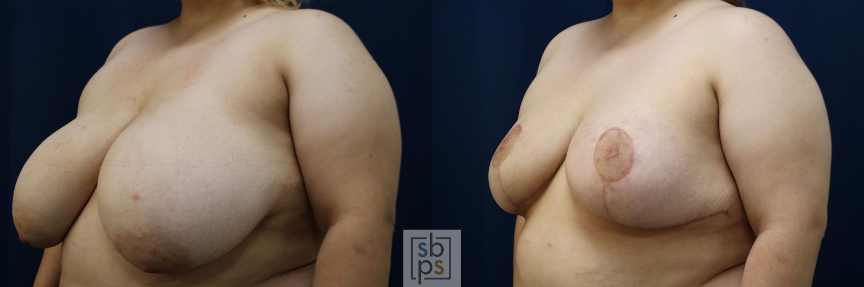 Before & After Breast Reduction Case 769 Left Oblique View in Los Angeles, Torrance & Long Beach, CA