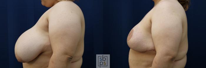 Before & After Breast Reduction Case 769 Left Side View in Los Angeles, Torrance & Long Beach, CA