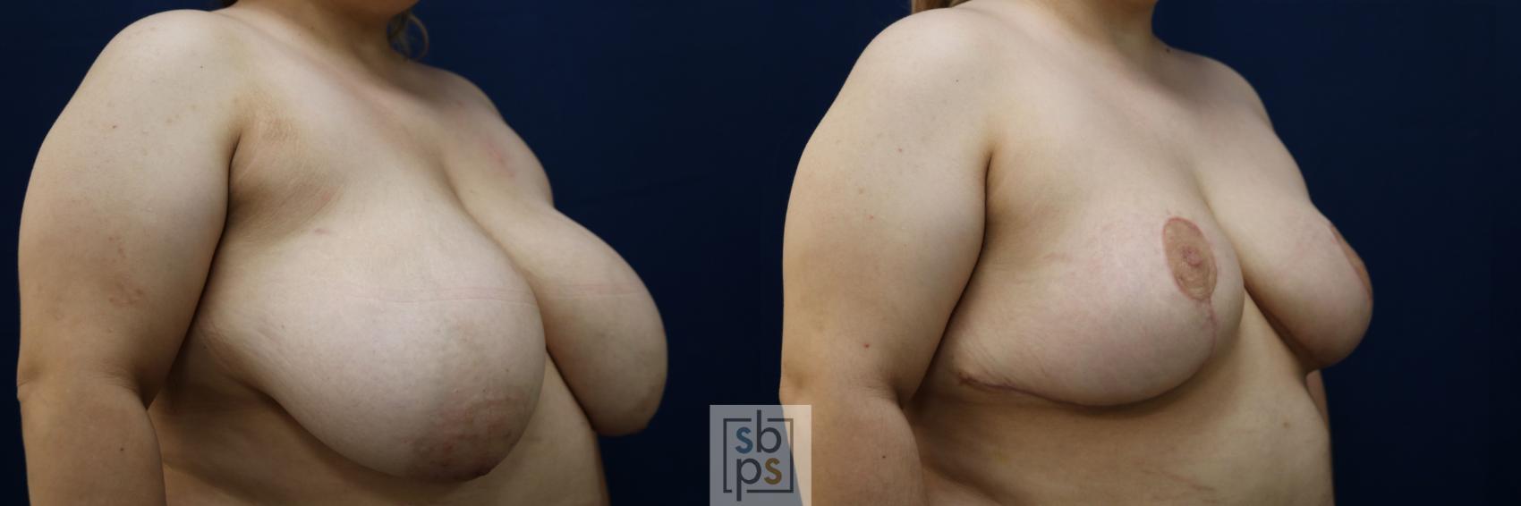 Before & After Breast Reduction Case 769 Right Oblique View in Los Angeles, Torrance & Long Beach, CA