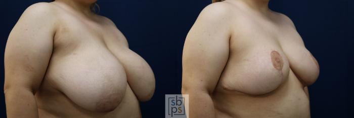 Before & After Breast Reduction Case 769 Right Oblique View in Los Angeles, Torrance & Long Beach, CA