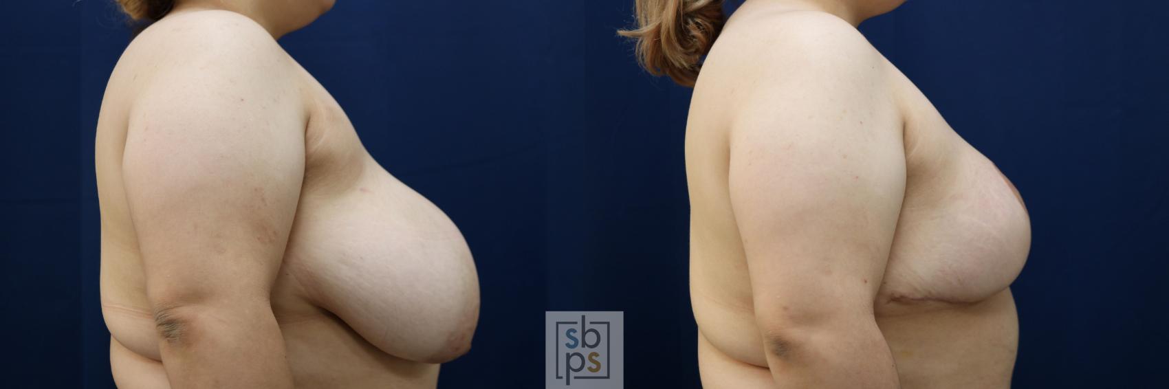 Before & After Breast Reduction Case 769 Right Side View in Los Angeles, Torrance & Long Beach, CA