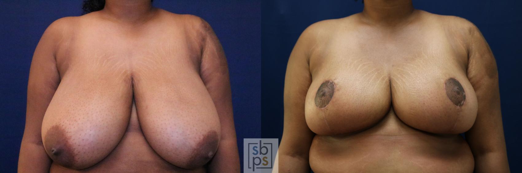 Before & After Breast Reduction Case 770 Front View in Los Angeles, Torrance & Long Beach, CA
