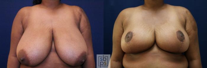 Before & After Breast Reduction Case 770 Front View in Los Angeles, Torrance & Long Beach, CA