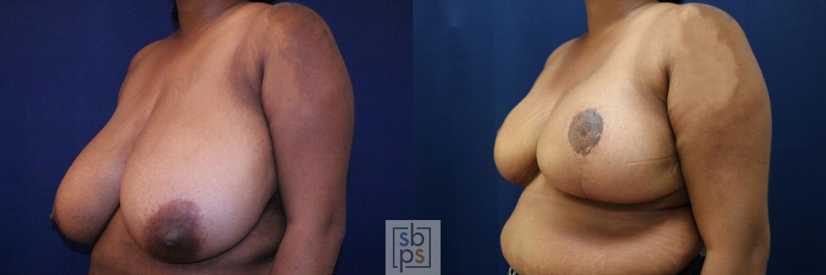 Before & After Breast Reduction Case 770 Left Oblique View in Los Angeles, Torrance & Long Beach, CA