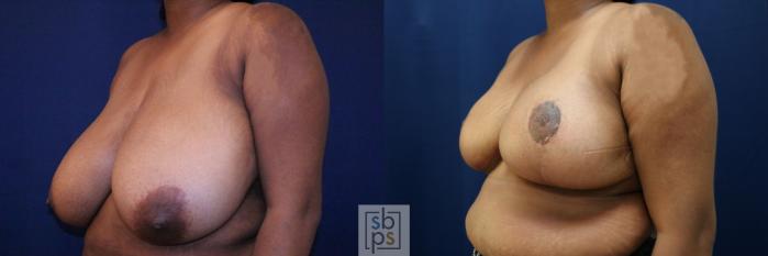 Before & After Breast Reduction Case 770 Left Oblique View in Los Angeles, Torrance & Long Beach, CA