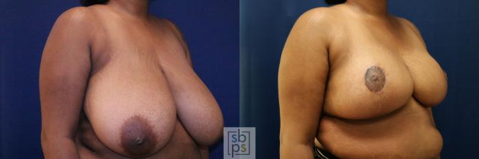 Before & After Breast Reduction Case 770 Right Oblique View in Los Angeles, Torrance & Long Beach, CA