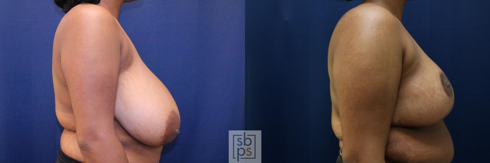 Before & After Breast Reduction Case 770 Right Side View in Los Angeles, Torrance & Long Beach, CA