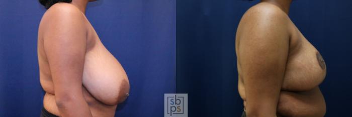 Before & After Breast Reduction Case 770 Right Side View in Los Angeles, Torrance & Long Beach, CA