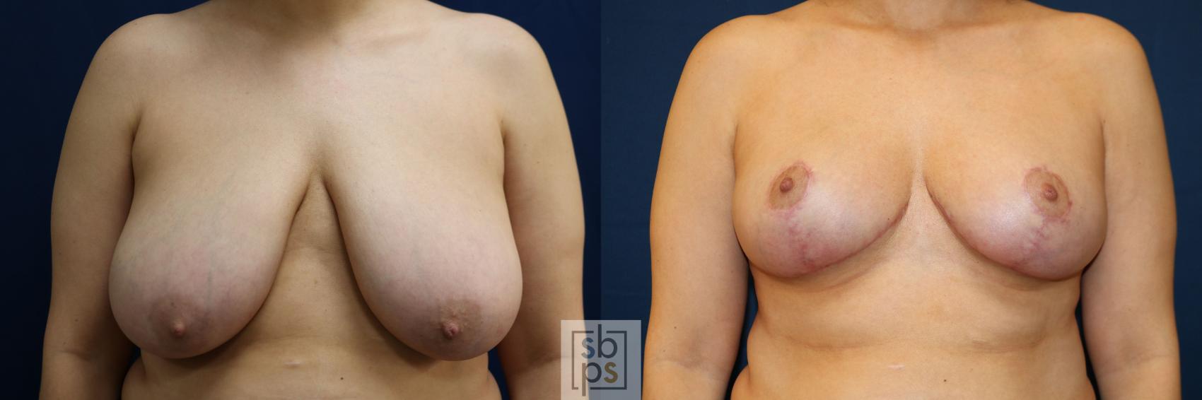 Before & After Breast Reduction Case 771 Front View in Los Angeles, Torrance & Long Beach, CA