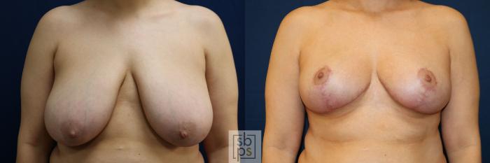 Before & After Breast Reduction Case 771 Front View in Los Angeles, Torrance & Long Beach, CA