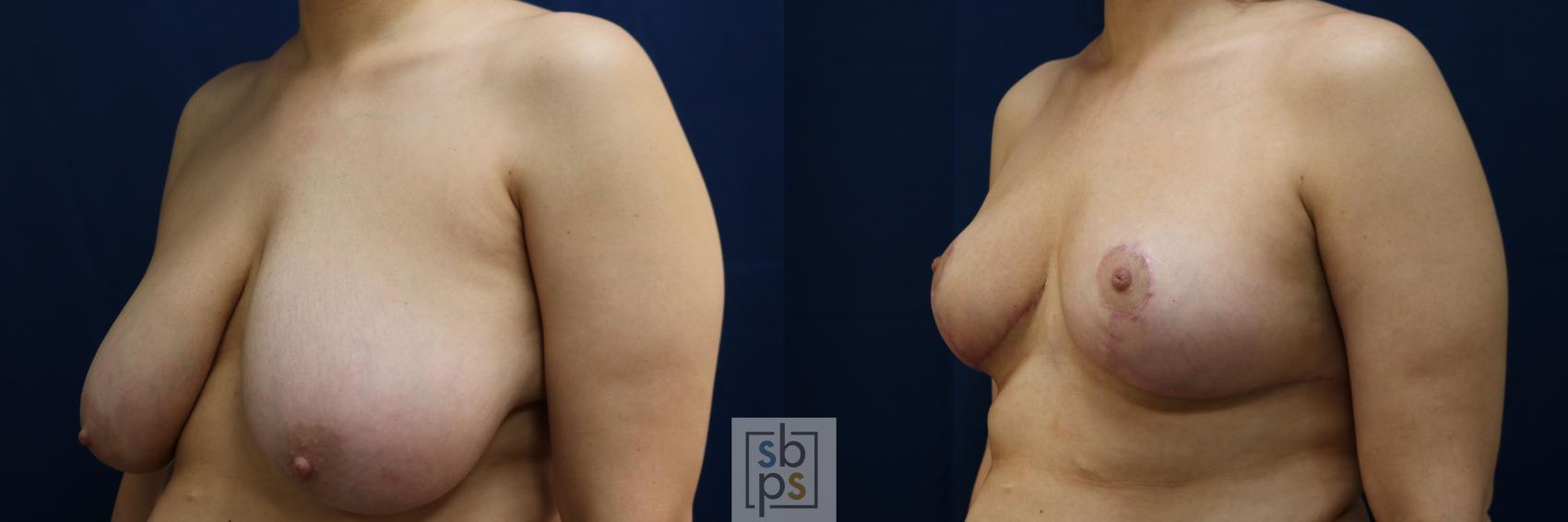 Before & After Breast Reduction Case 771 Left Oblique View in Los Angeles, Torrance & Long Beach, CA