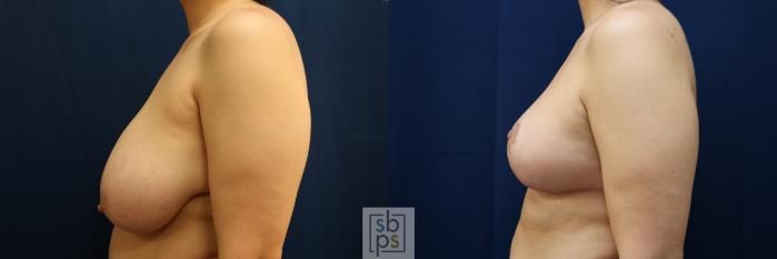 Before & After Breast Reduction Case 771 Left Side View in Los Angeles, Torrance & Long Beach, CA