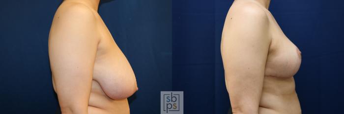 Before & After Breast Reduction Case 771 Right Side View in Los Angeles, Torrance & Long Beach, CA