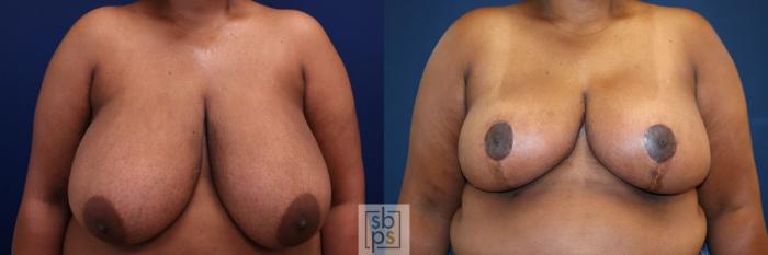 Before & After Breast Reduction Case 772 Front View in Los Angeles, Torrance & Long Beach, CA