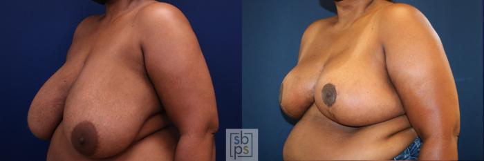 Before & After Breast Reduction Case 772 Left Oblique View in Los Angeles, Torrance & Long Beach, CA