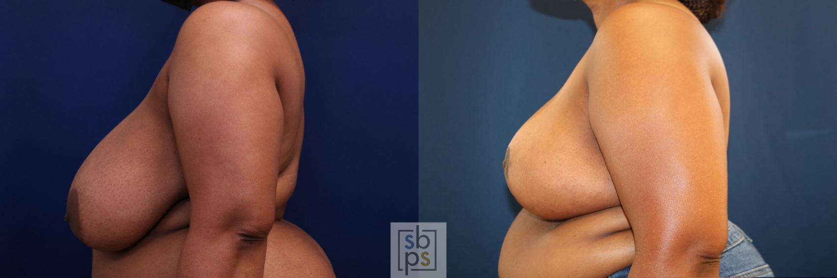 Before & After Breast Reduction Case 772 Left Side View in Los Angeles, Torrance & Long Beach, CA