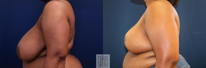 Before & After Breast Reduction Case 772 Left Side View in Los Angeles, Torrance & Long Beach, CA