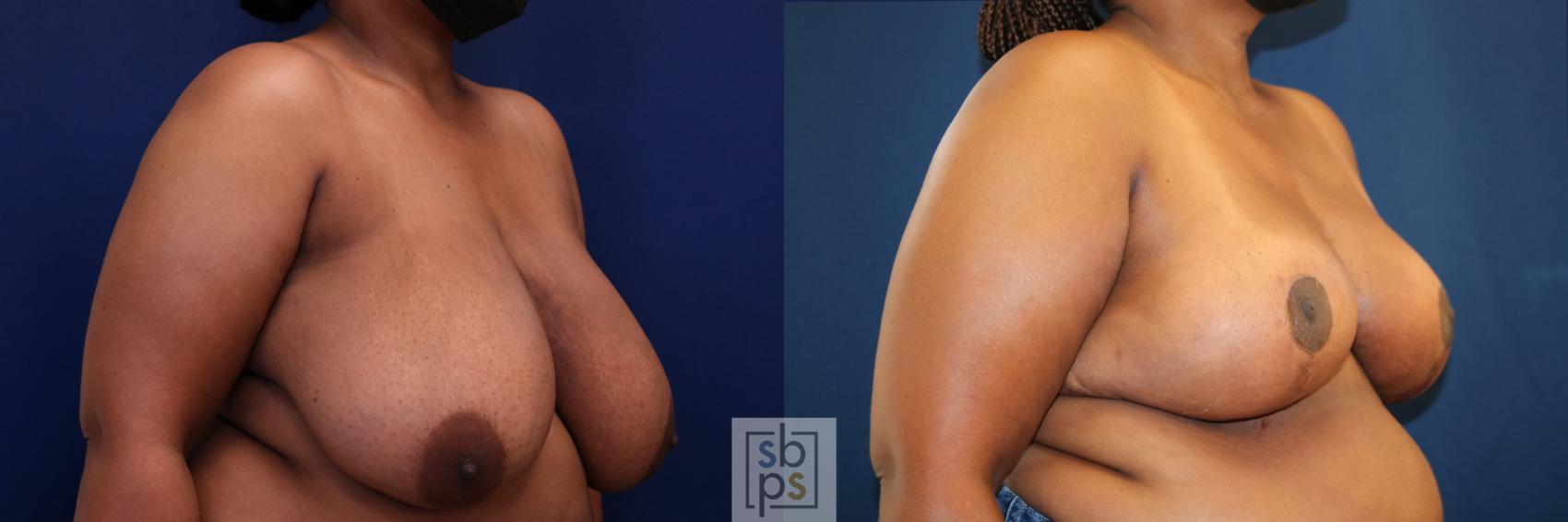 Before & After Breast Reduction Case 772 Right Oblique View in Los Angeles, Torrance & Long Beach, CA