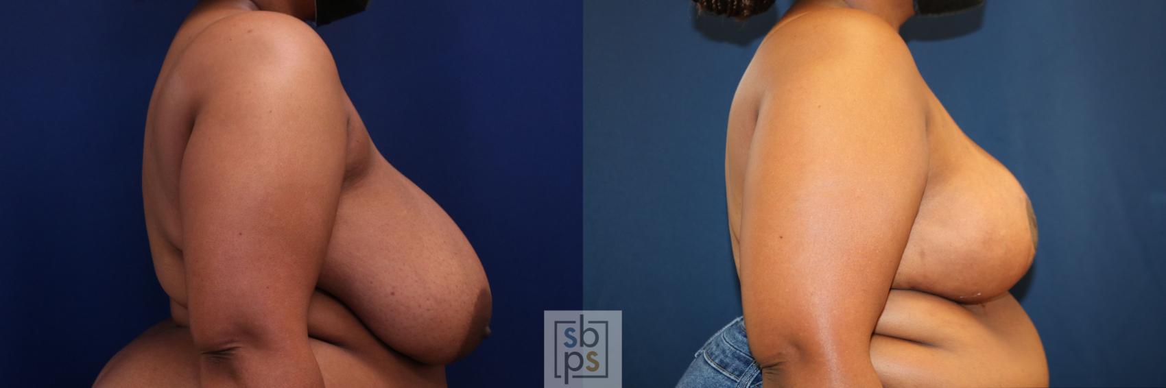 Before & After Breast Reduction Case 772 Right Side View in Los Angeles, Torrance & Long Beach, CA