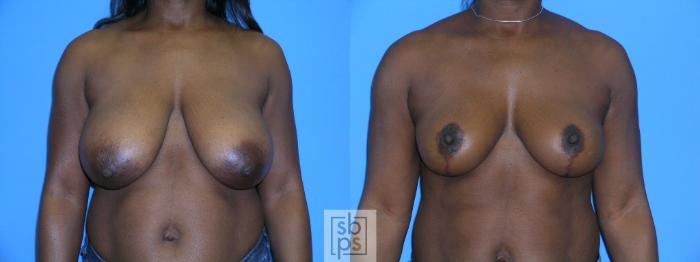 Before & After Breast Reduction Case 87 View #1 View in Torrance, CA