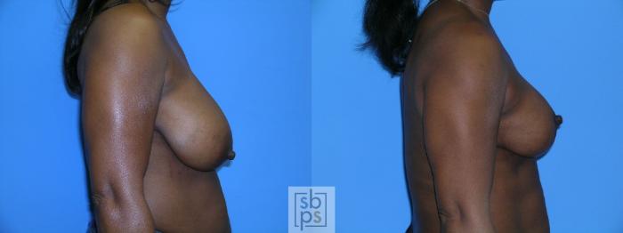 Before & After Breast Reduction Case 87 View #2 View in Torrance, CA