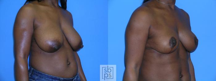 Before & After Breast Reduction Case 87 View #3 View in Torrance, CA